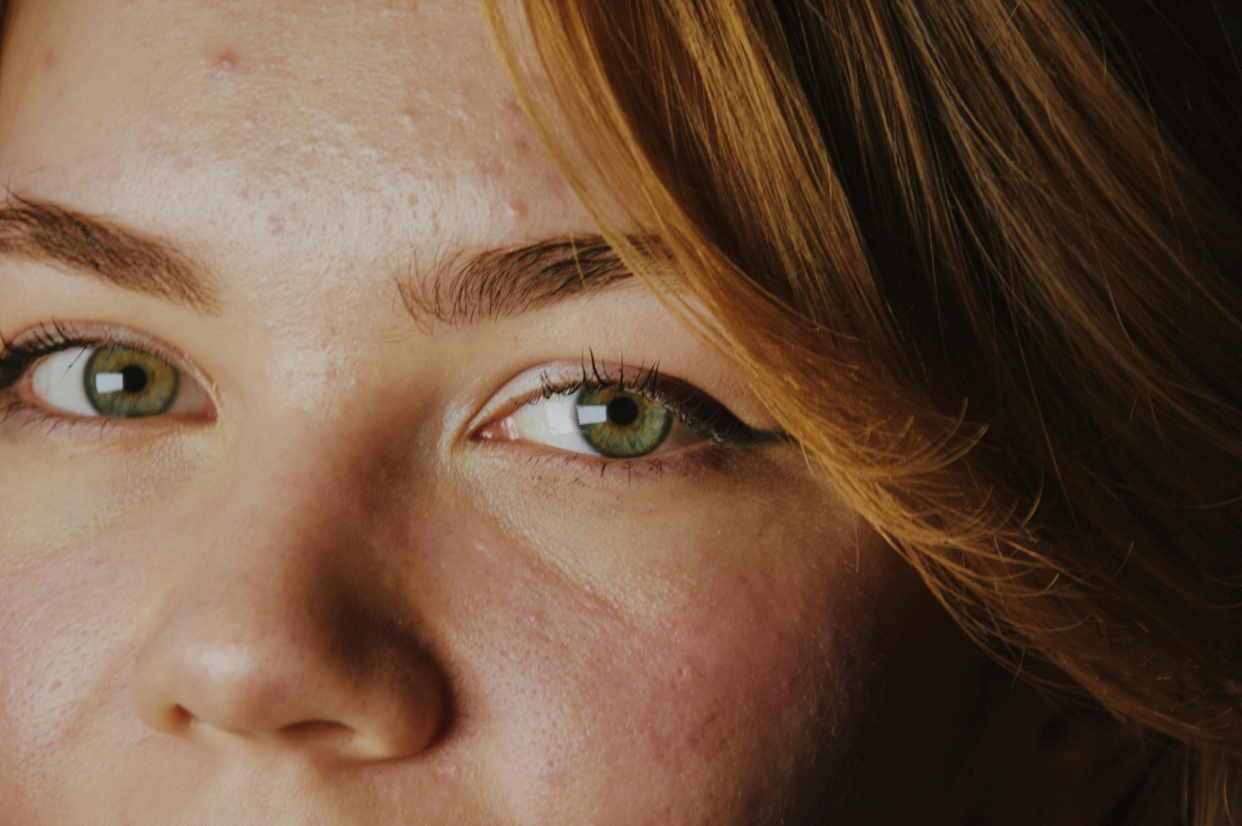 Fungal Infection on Face