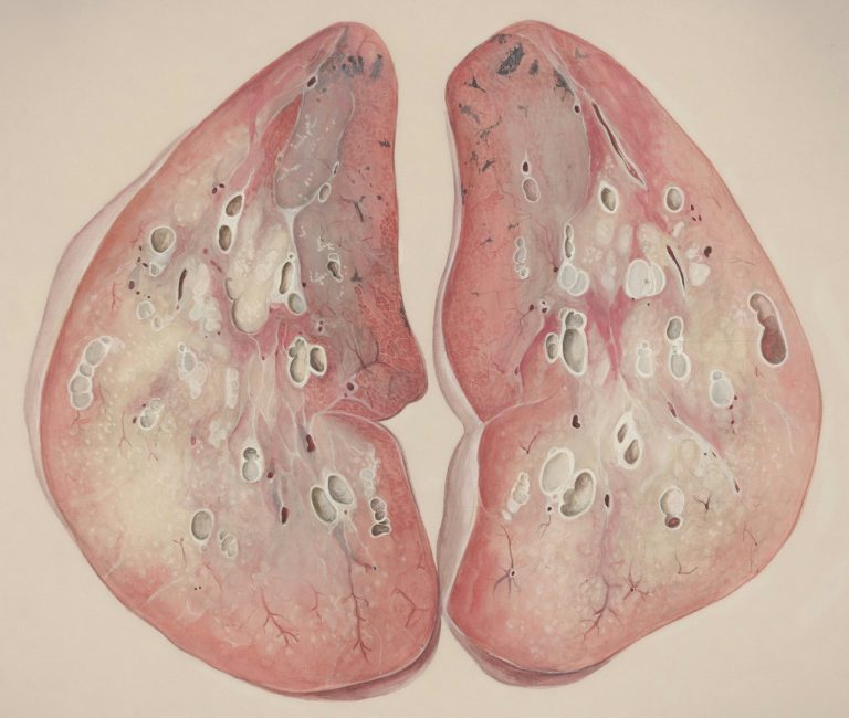 White Lung Pneumonia: Ohio Outbreak 2026
