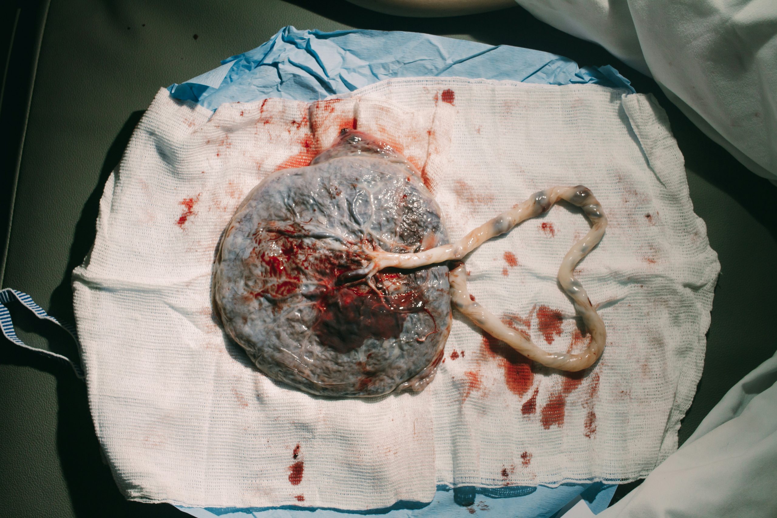 miscarriage blood clots