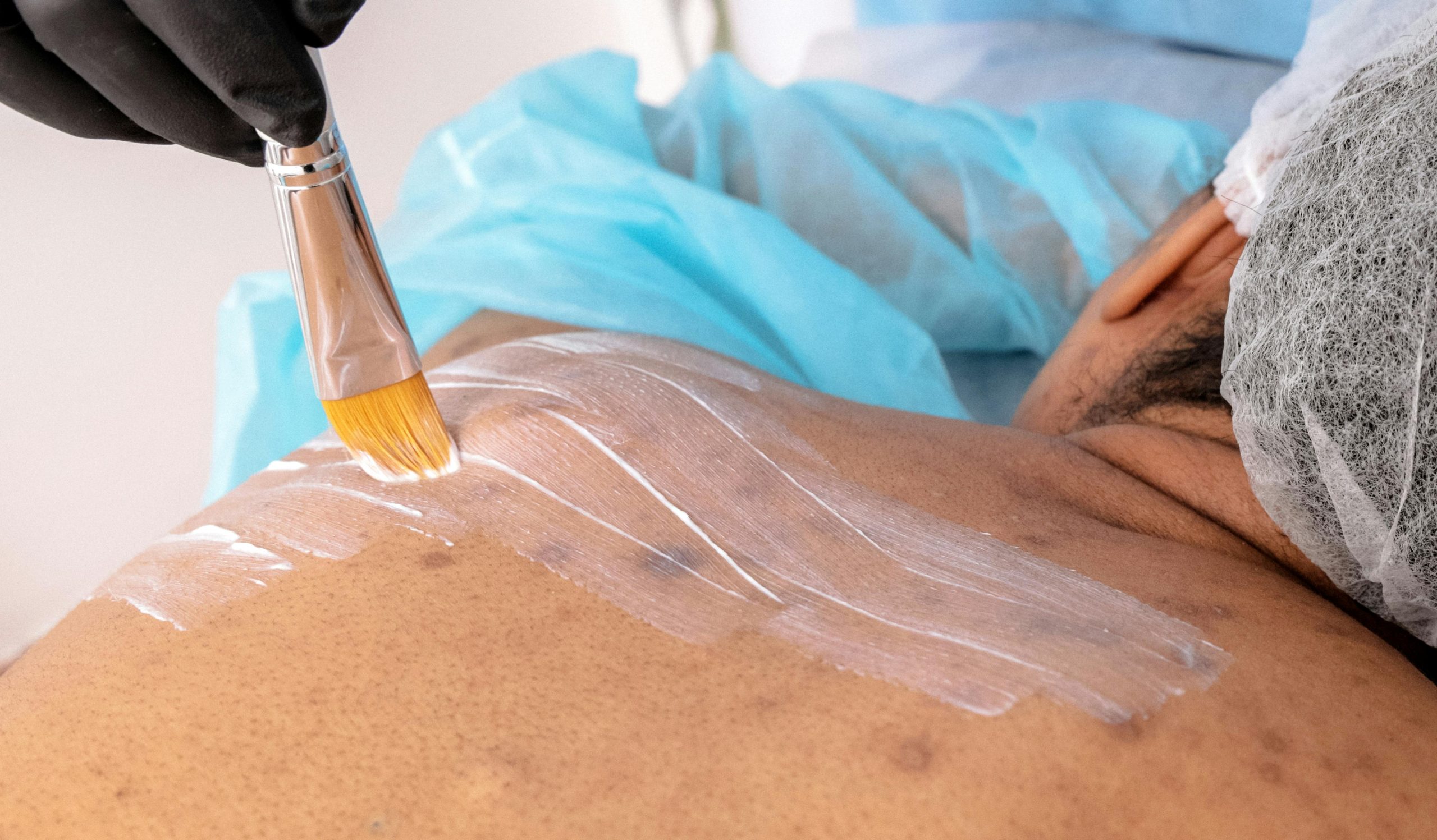 skin lesions